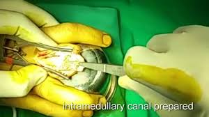Published may 05, 21 4:40am. Pipj Swanson Arthroplasty Youtube