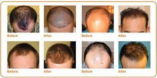 In order to experience the complete result of a hair transplant, the patient needs to wait for six to nine months. Who Is Suitable For Hair Transplant Surgery
