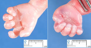 In addition, there is a higher incidence of pneumonia in children with down syndrome than in the general population. Pin On Down Syndrome Hands Trisomy 21