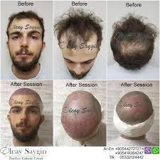 Best Hair Transplant Doctor In Turkey Hair Transplant Best Hair Transplant Hair Transplant Results