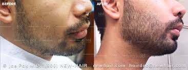 It can be done to restore the beard, moustache, goatee as well as the sideburns or for that matter anywhere that hair is desired even if the hair has never grown in that area before. Say Goodbye To Patchy Beards With Nhi Medical Hair Restoration