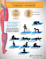 Pin On Sciatica Pain Relief Exercises