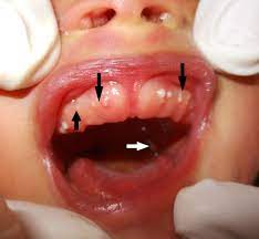 Bohn's nodules: an under-recognised entity | ADC Fetal & Neonatal Edition