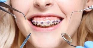 How Long Do You Have to Have Braces? Duration, Tips, and Factors Explained  - Ferris Orthodontics