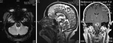 Kavernome Uniklinik Essen