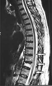 Transverse myelitis postsurgical spine avm brachial plexus post radiation therapy, eval for mass lesions, entrapment, denervation cervical spine w and w/o contrast 72156 thoracic disc disease pain radiculopathy trauma thoracic spine w/o contrast 72146 tumor infection ms syrinx transverse myelitis postsurgical spine avm Post Covid 19 Longitudinally Extensive Transverse Myelitis Letm A Case Report Springerlink