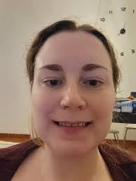 19 days post double jaw surgery : r/UARSnew