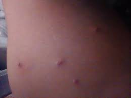 Bolas Con Pus En La Ingle Resuelto