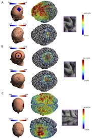 Spatial learning and memory are largely unaffected in glua1 knockout mice despite the fact that ltp is reduced in ca1 and ca3 (zamanillo, 1999) and working memory is diminished (reisel et al., 2002 Accessibility Of Cortical Regions To Focal Tes Dependence On Spatial Position Safety And Practical Constraints Sciencedirect