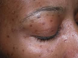 Image result for Postinflammatory Hypopigmentation