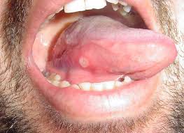 Canker Sore Treatments Causes And Symptoms