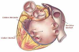Chirurgische Ablation Bei Vorhofflimmern
