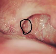 The term leukoplakia literally means white patch (leuko means white and plakia means patch). White Dot At Back Of Throats Where Tonsil Used To Be Oral And Dental Problems Forums Patient