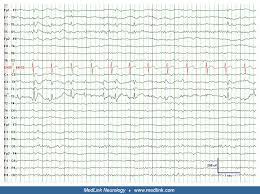 Dont forget to read the other manga updates. Eeg In Epilepsy Medlink Neurology