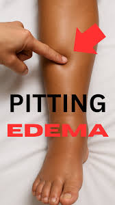 Image result for Edema