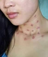 Ada banyak cara hilangkan jeragat ni. Digigit Suami Tips Untuk Hilangkan Love Bite Dengan Mudah What Happen