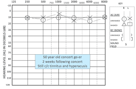 Lori loud rumble roses : Acoustic Trauma From Recreational Noise Exposures Brian J Fligor Hearing And Hearing Loss Hearing Conservation And Nihl 23542