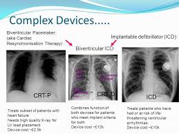 David rhine explains the differences between and functions of pacemakers and an defibrillator. Biventricular Icd Vs Pacemaker