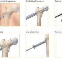 7.3 mm Locking Cannulated Screw Uses & Sizes • Vast Ortho