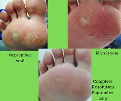 Some can also disappear on their own accord. Make Your 2020 Resolution To See A Podiatrist West Berkshire Foot Clinic