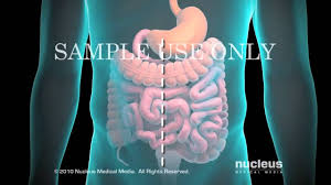 Colon Resection Surgery Recovery Colon Gastroparesis