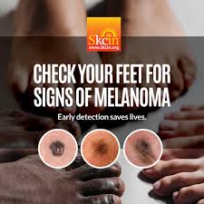 Image result for Acral lentiginous melanoma nail