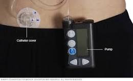 Image result for what is the treatment plan for type i diabetes