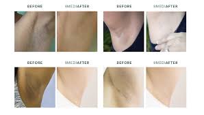 First, peel your cucumber and cut them into pieces, then blend them. Underarms Armpit Whitening Treatment Best Skin Treatment In Singapore