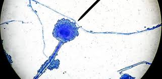 La mucormicosis es causada por la exposición al hongo mucor, que es parte de la familia mucoraceae. 6 Preguntas Claves Para Entender El Hongo Negro Que Ataca A Pacientes De Covid 19