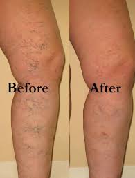 Results Can Be This Good Pichelp Varicose Vein Remedy Veins Treatment Spider Veins