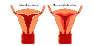 Obat mengatasi penebalan dinding rahim. Penebalan Dinding Rahim Penyebab Ciri Ciri Pantangan Makanan Deherba Com