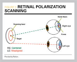 vision screening update new device detects amblyopia and