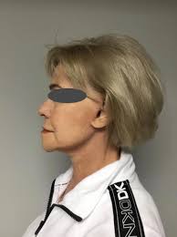 Mini Facelift Case Study 7