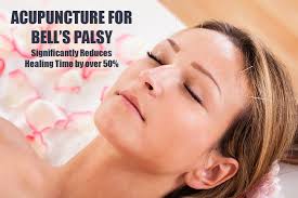 Generally patients are under the age of fifteen or over sixty. Acupuncture For Bell S Palsy Palm Beach Gardens