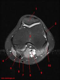 Mri patterns of neuromuscular disease involvement thigh & other muscles 2. Atlas Of Knee Mri Anatomy W Radiology