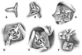 Image result for Purse String Suture