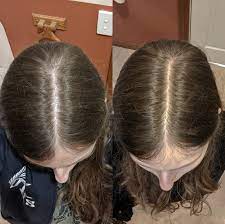 It can also have hormonal effects by blocking the action of androgens, male hormones, that are normally produced by women in low levels. Month 4 And Month 6 On Spironolactone 150mg And Minox 5 Femalehairloss