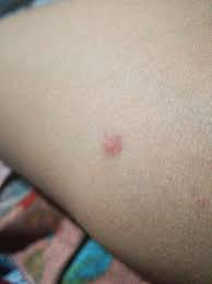 Picor Prurito Pagina 2 Dermatologo Net