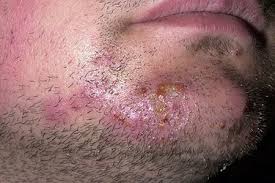 It is caused by a fungus that can live on skin, surfaces like gym floors, and household items like towels, bedding, and clothes. Ringworm Pictures What A Ringworm Rash Looks Like