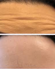How long does botox take to start working? Your Experiences Of Botox Mumsnet