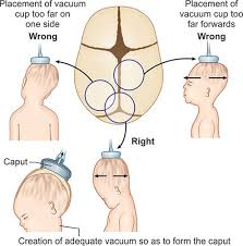 Image result for Vacuum Caput