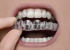 How To Take Care Of Retainers After Braces After Braces Orthodontics Retainers Braces Retainer