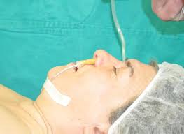 The nasal cannula is a device used to deliver supplemental oxygen or increased airflow to a patient or this device consists of a lightweight tube which on one end splits into two prongs which are placed in the. Lateral View Of A 57 Year Old Woman Connected To The Etco 2 Monitor Download Scientific Diagram