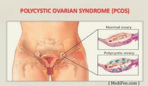 Akan tetapi berkenaan dengan kapan terjadinya, (hari, tanggal, bulan dan. Makan Supplemen Tak Boleh Rawat Ovarian Cyts Doktor Nasihat Wanita Supaya Tak Tertipu