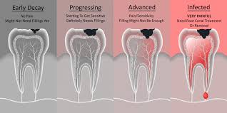 How to know if you need a root canal reddit. Tooth Decay Problems Berwick Dental Studio