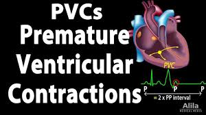 Premature Ventricular Contractions Pvcs Animation Premature Contractions School Levels