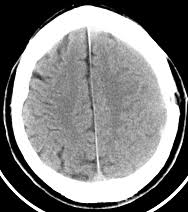 Se l'aneurisma cerebrale si rompe, l'emorragia di solito dura per pochi secondi, ma il sangue può la tomografia computerizzata (tc o tac) della testa è una tecnica diagnostica veloce le immagini possono essere visualizzate sia in tre dimensioni, sia come sezioni trasverse del cervello e dei vasi. La Dignostica Per Immagini Nella Pratica Clinica Tc Multidetettore