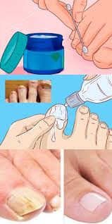 как вылечить грибок ногтя на ноге в домашних условиях Eti 6 Moshnyh Sredstv Ustranyat Dazhe Samyj Zapushennyj Gribok Nogtej Fitness Healthy Lifestyle Nail Fungus Helpful Hints