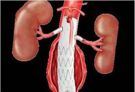 This is aneurisma de aorta by martin almada on vimeo, the home for high quality videos and the people who love them. Reparado Un Aneurisma De Aorta En Un Paciente Con Epoc Mediante Una Endoprotesis Fenestrada A Medida Jano Es Elsevier