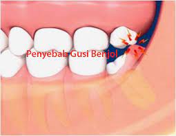 Check spelling or type a new query. Penyebab Gusi Benjol Rumah Sakit Karanggede Sismamedika